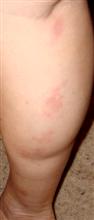 Psoriasis on leg after